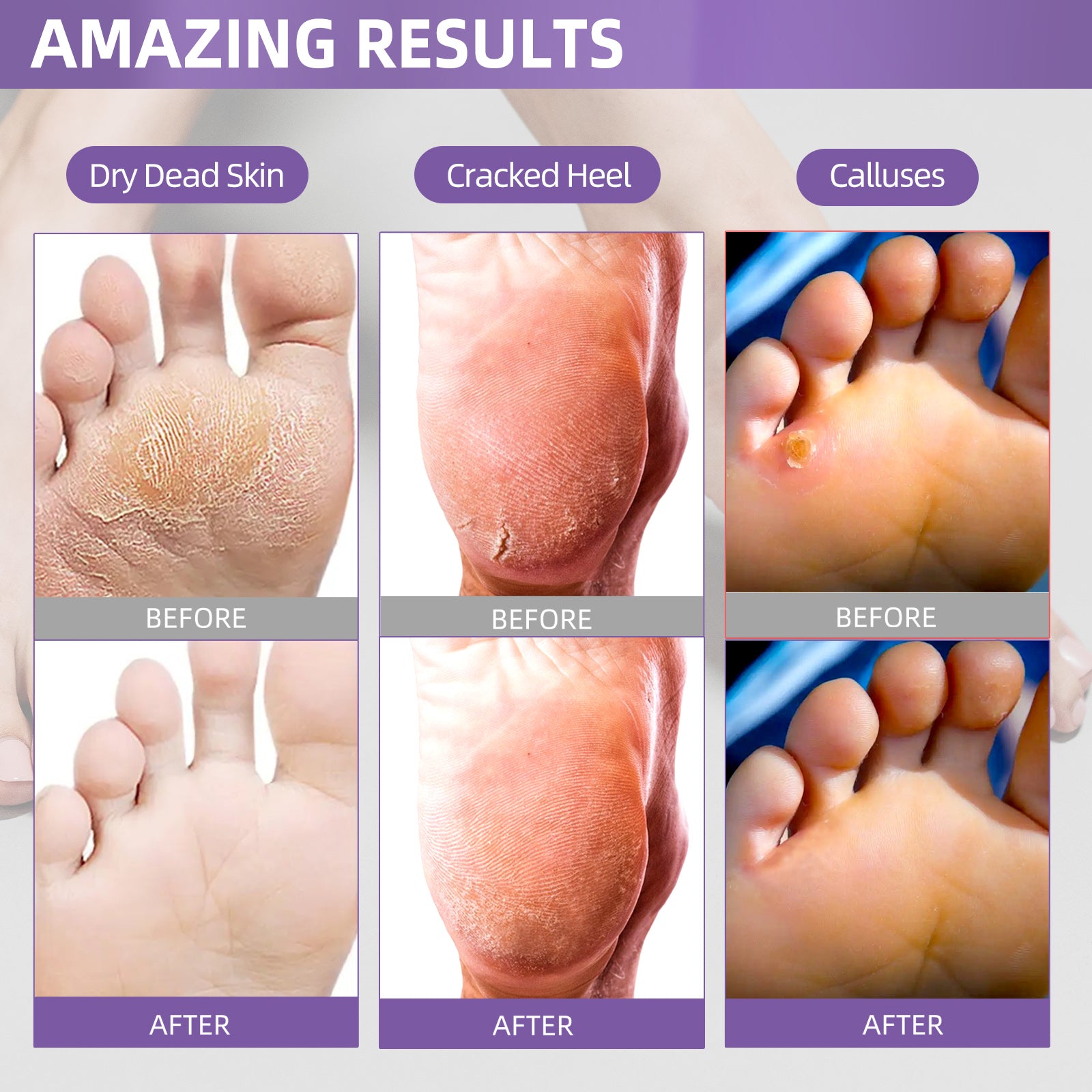 Feet dead hot sale skin peel